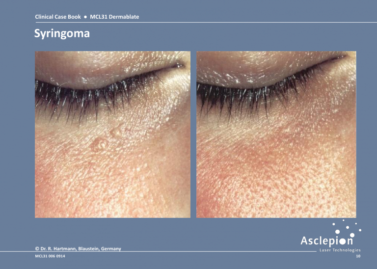 Skin Resurfacing Treatment - Syringoma Before & After Result