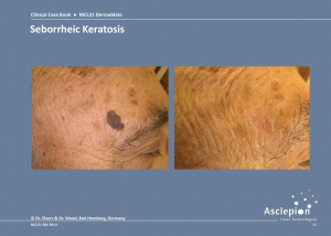 Skin Resurfacing Treatment - Seborrheic Keratosis Before & After Result