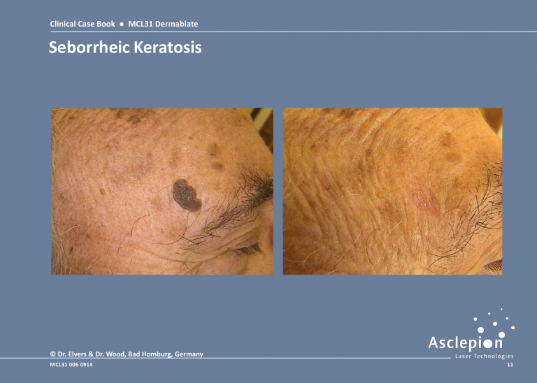 Skin Resurfacing Treatment - Seborrheic Keratosis Before & After Result