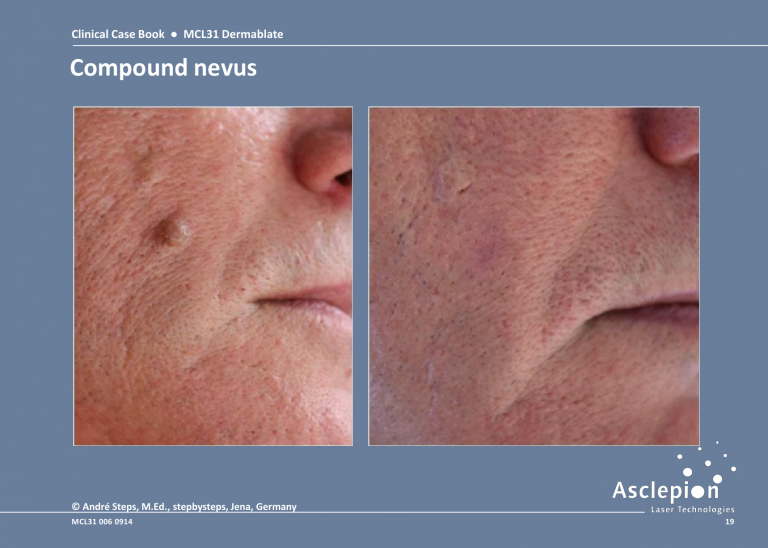 Skin Resurfacing Treatment - Compound nevus Before & After Result
