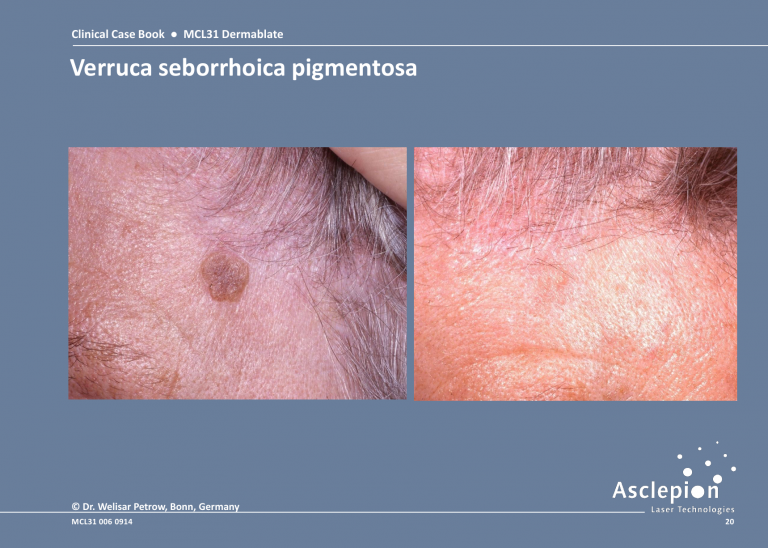 Skin Resurfacing Treatment - Verruca seborrhoica pigmentosa Before & After Result