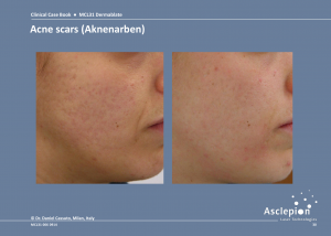 Scar Treatment Before and After Result