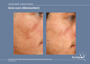 Scar Treatment Before and After Result