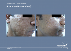 Scar Treatment Before and After Result