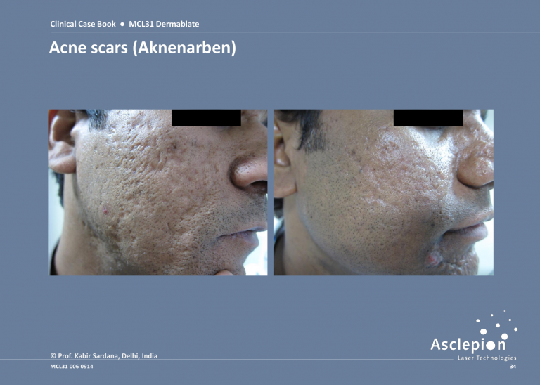 Scar Treatment Before and After Result