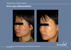 Scar Treatment Before and After Result