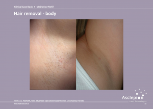 Before and After Laser Hair Removal