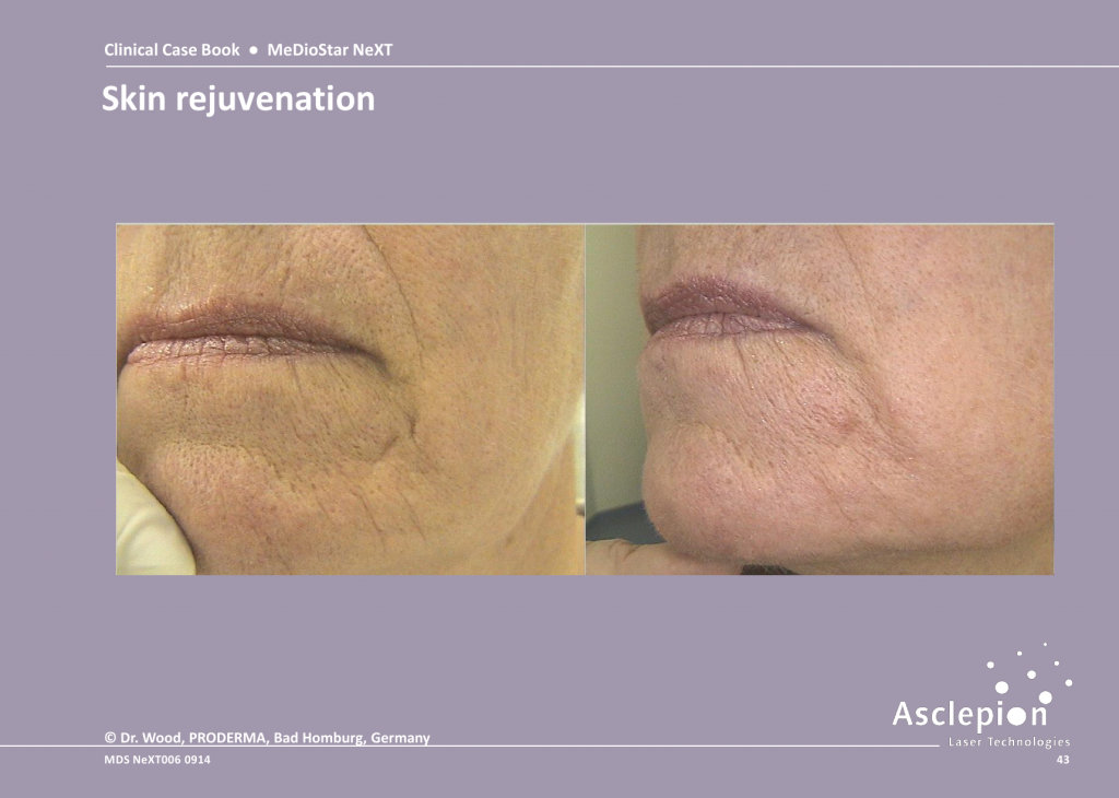 Skin Tightening Treatment Before and After Result