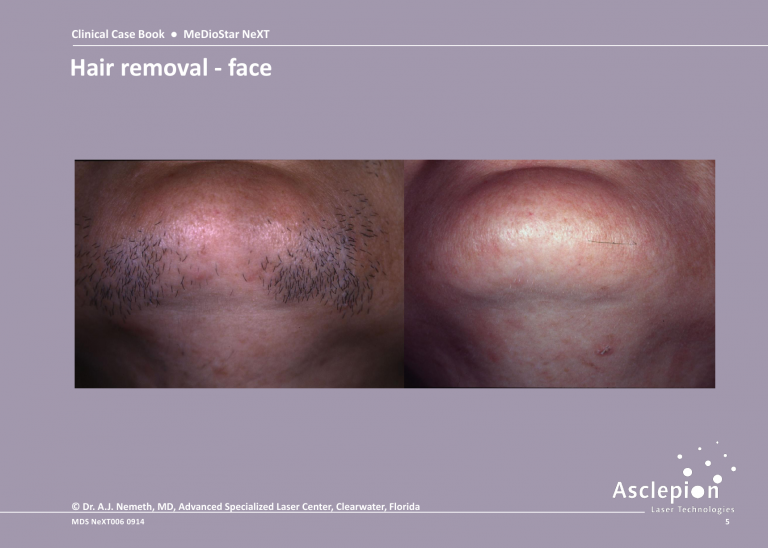 Before and After Laser Hair Removal