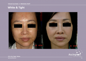 Skin Tightening Treatment Before and After Result