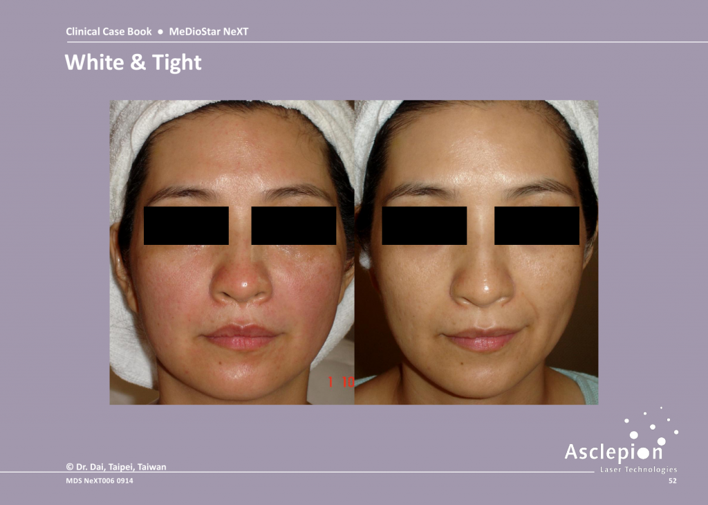 Skin Tightening Treatment Before and After Result