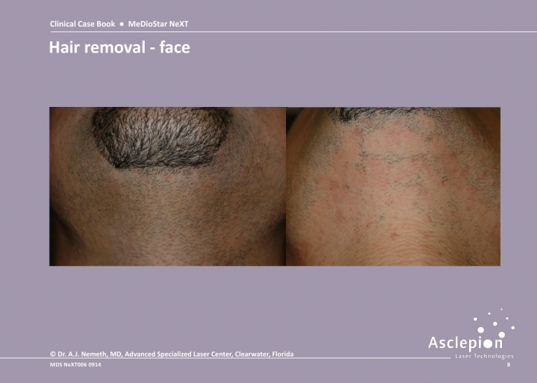 Before and After Laser Hair Removal