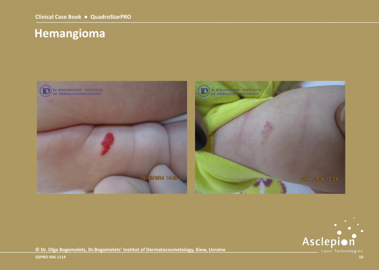 Before and After Treatment of Hemangioma