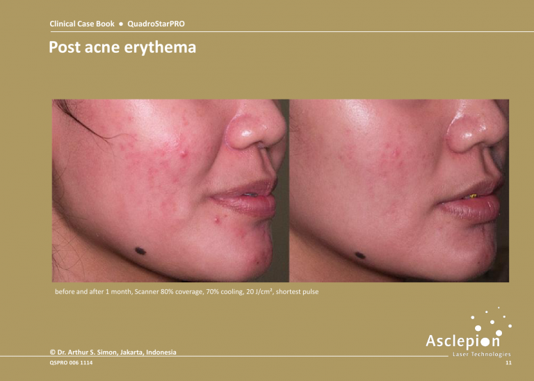 Before and After Treatment of Post acne erythema