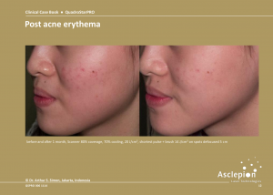 Before and After Treatment of Post acne erythema