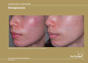 Before and After Treatment of Telangiectasia