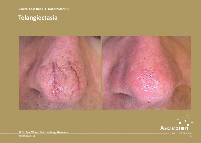 Before and After Treatment of Telangiectasia