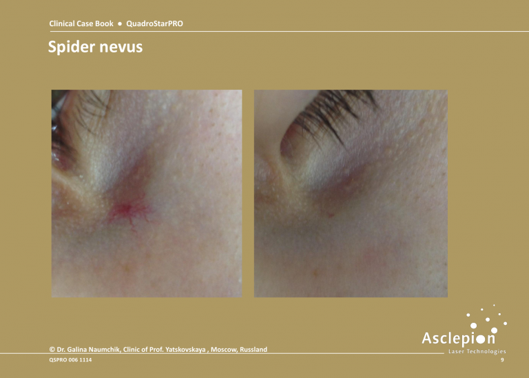 Before and After Treatment of Spider nevus