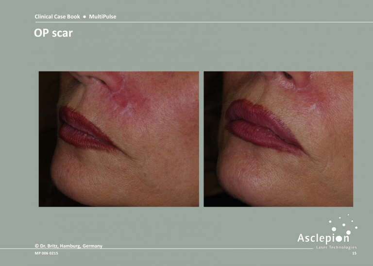 Treatment of OP Scar - Before and After Result