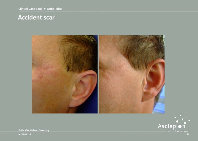 Treatment of Accident Scar - Before and After Result