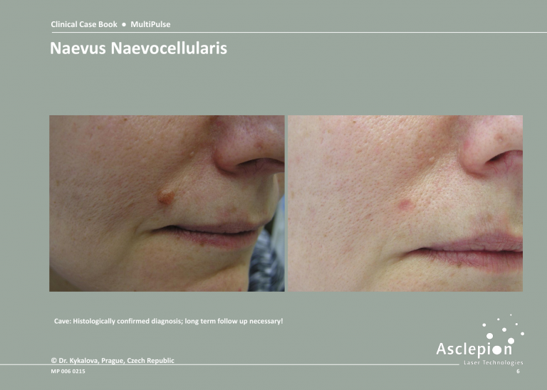 Skin Resurfacing Treatment - Naevus Naevocellularis Before & After Result