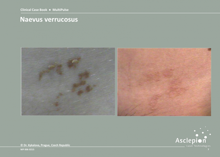 Skin Resurfacing Treatment - Naevus verrucosus Before & After Result