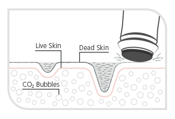 OxyGeneo Treatment exfoliating the top layer of skin