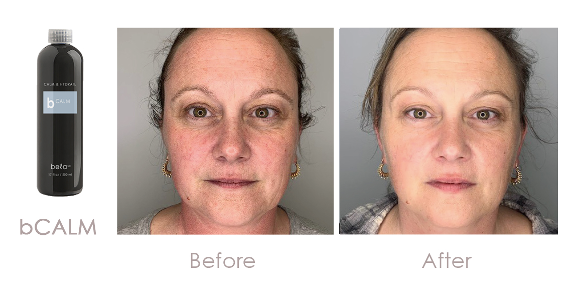 Bela MD bCALM Serum Before and After Result