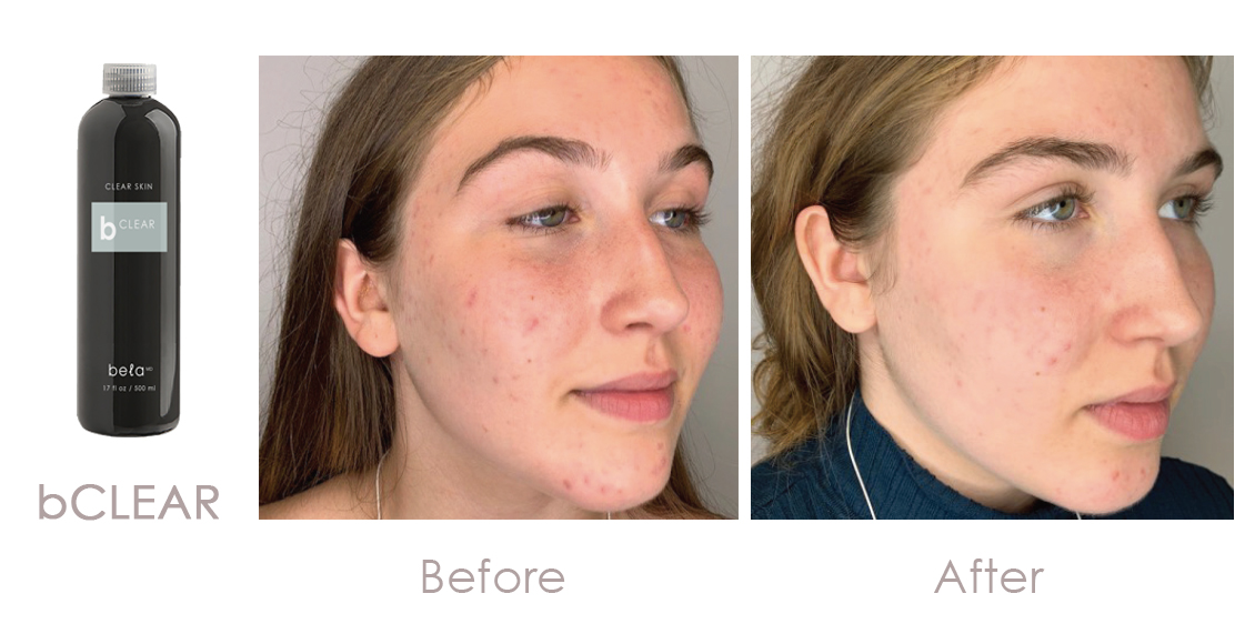 Bela MD bCLEAR Serum Before and After Result