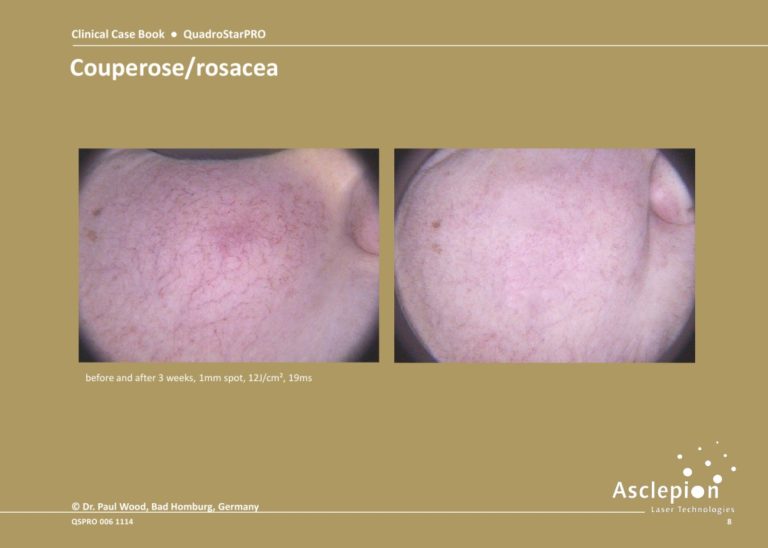 Before and After Treatment of Couperose/rosacea