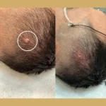 Skin Tag Removal