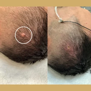 Skin Tag Removal