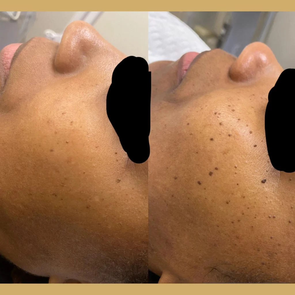 Skin Tag Removal before and after