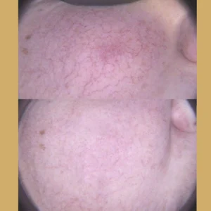 rosacea removal