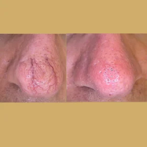 laser to remove broken capillaries