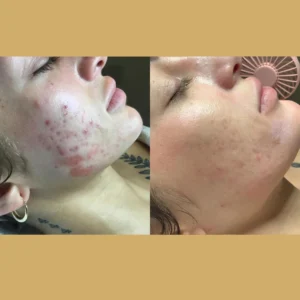 acne scar removal