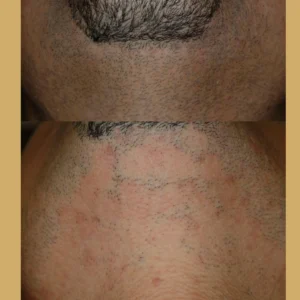 laser hair removal