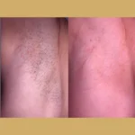 laser hair removal near me