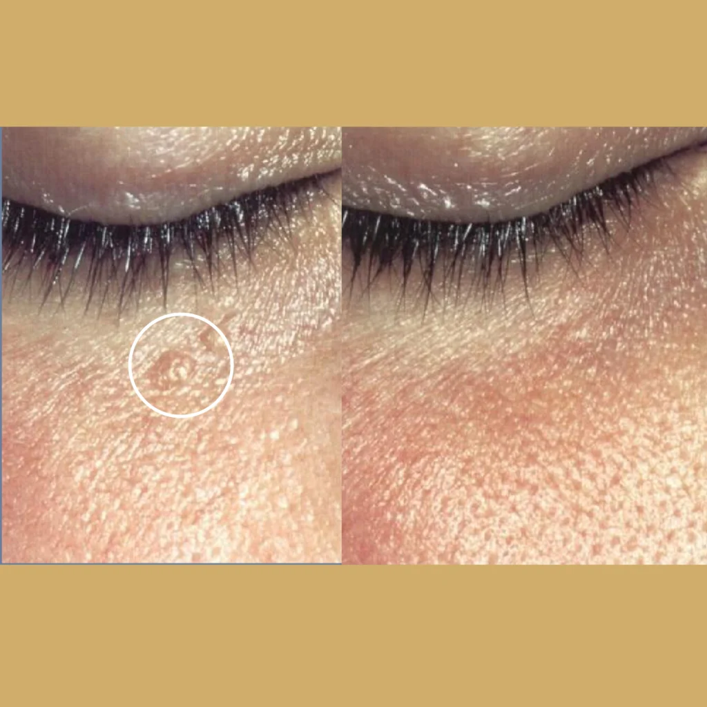 laser skin resurfacing before and after