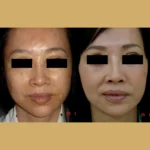 skin whitening treatment