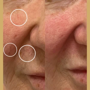 rosacea treatment