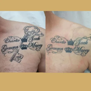 tattoo removal near me