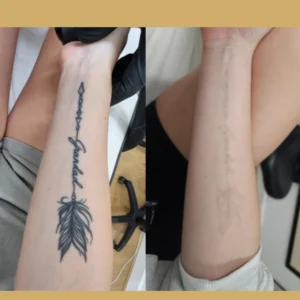 tattoo removal before and after