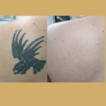 tattoo laser removal near me