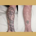 laser tattoo removal