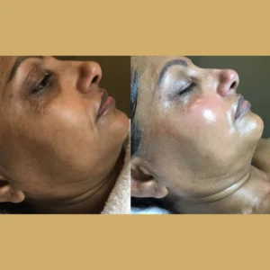 Depigment Chemical Peel