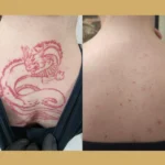 tattoo removal before after