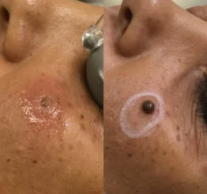 mole removal before and after