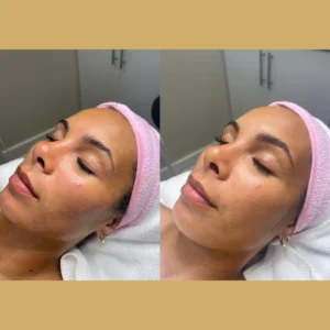 oxygeneo facial