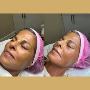 rf microneedling before